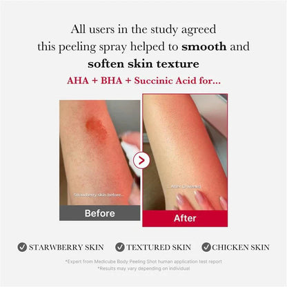 Red Acne Body Peeling Shot [110g]